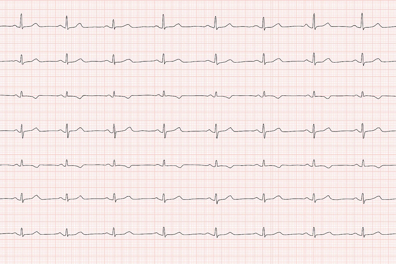 Palpitaciones sin cardiopatía: POTS/IST vs pánico (protocolo 2025)